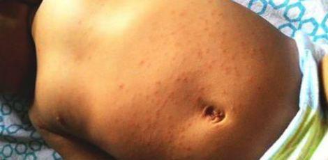 Doença causa erupção na pele, mas é mais branda que a dengue / Foto: Site UFBA